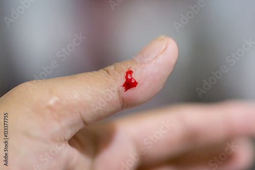 Closeup view of finger on left thumb human hand is cut hurt and bleeding with bright red blood.