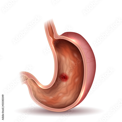 Stomach internal lining and ulcer, colorful drawing photo