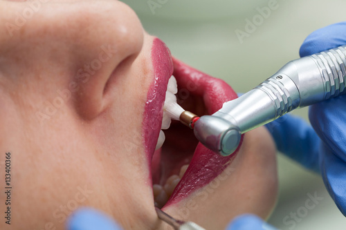 Dental polishing treatment