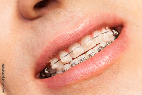 Canvas-taulu Man smiling showing dental braces
