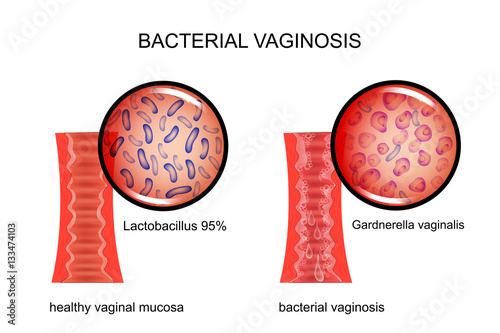 bacterial vaginosis. the vagina and the causative agent photo