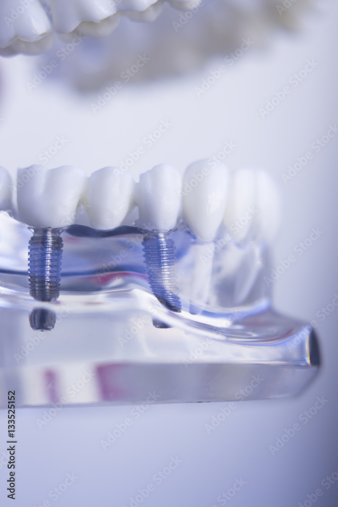 Dentists dental teeth implant Dentists dental teeth implant