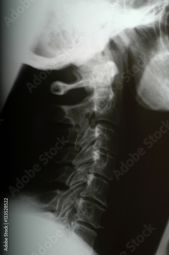 X-ray, spinal solumn (model-released) photo