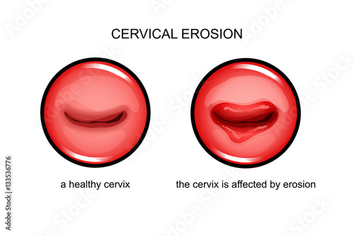 the cervix is affected by erosion photo