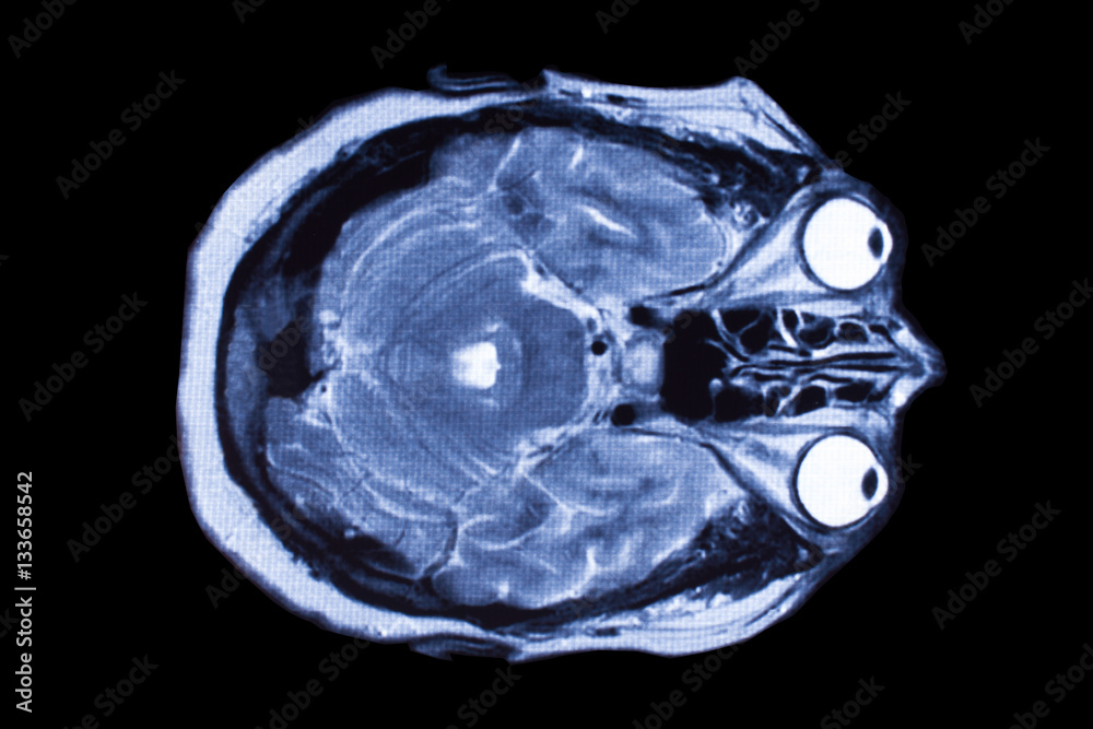 X-ray image of the brain computed tomography X-ray image of the brain computed tomography