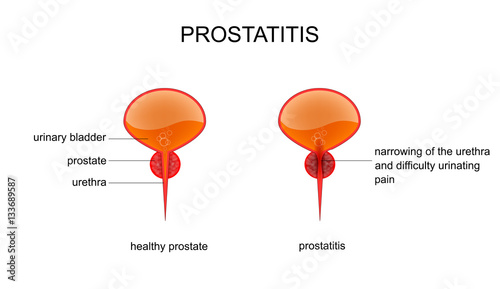 healthy prostate and prostatitis photo