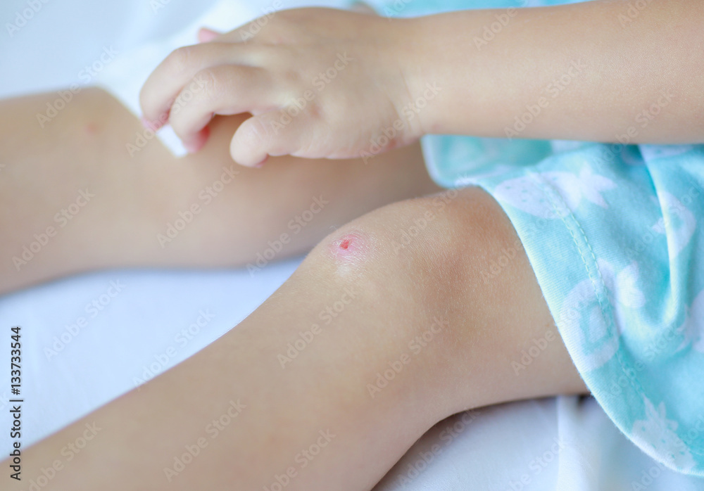 Close up wound on child knee. Mother dressing child's knee.