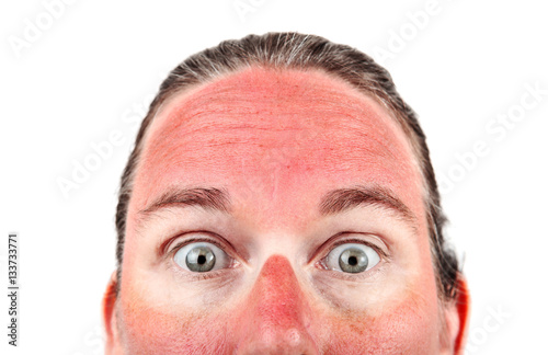 Woman with Sunglasess sunburn photo