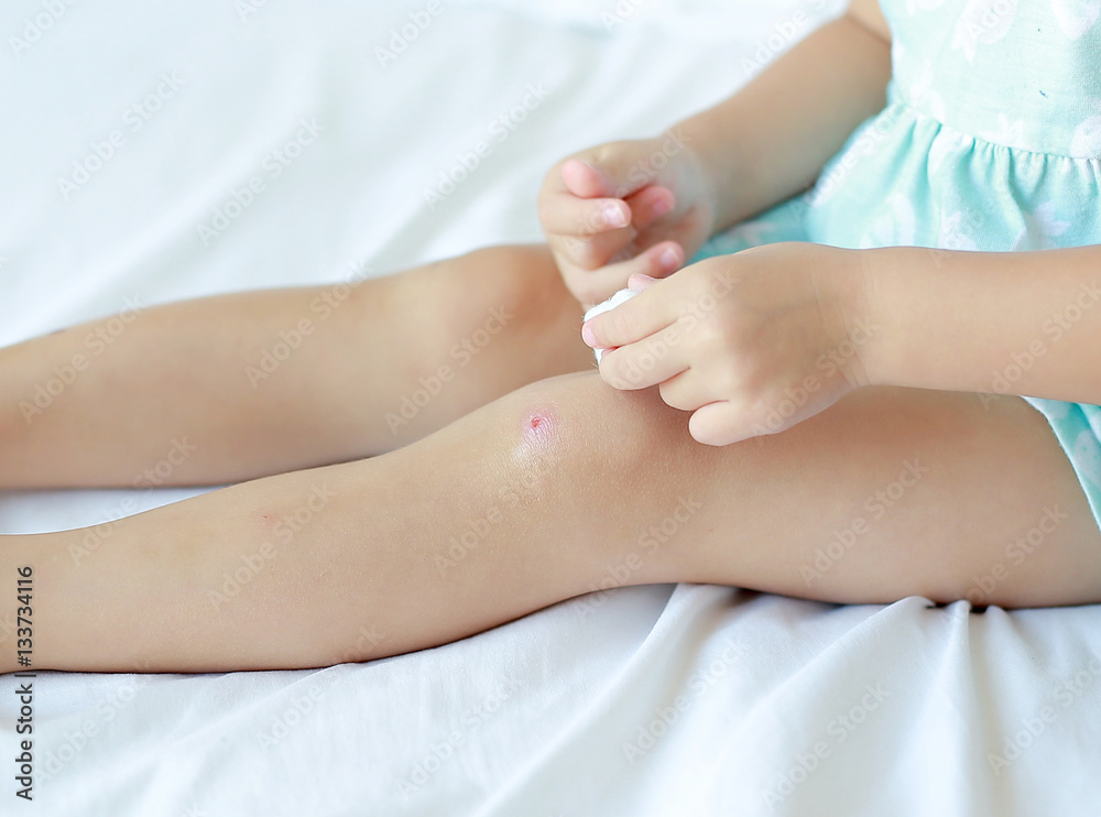 Close Up of child girl dressing wound on knee by self on the bed. Close Up of child girl dressing wound on knee by self on the bed.