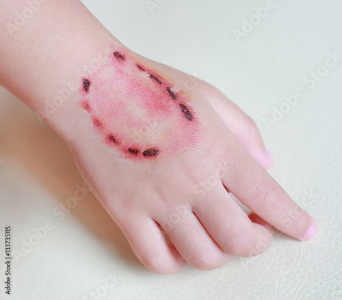 Canvas Print Sticker wound and blood from a bite human teeth on child hand, Dress up tattoos, Halloween concept
