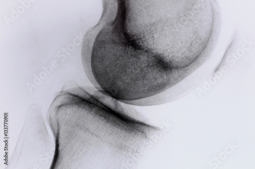 Photography X-ray of a woman, knee of a woman, 40-50 years, arthrosis (model
