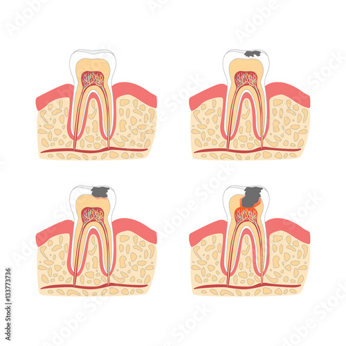 Cartoon Tooth with Stages of Dental Caries Formation Set. Vector
