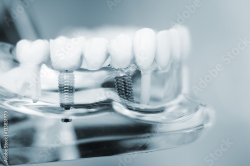 Dentists dental teeth implant photo