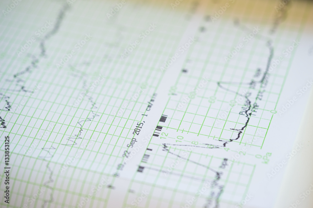 Printing of cardiogram report coming out from Electrocardiograph in labour ward Printing of cardiogram report coming out from Electrocardiograph in labour ward