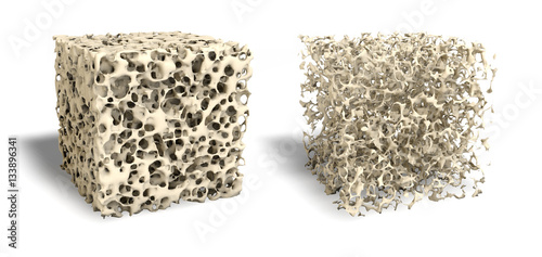 Healthy bone and osteporosis bone (right side) photo