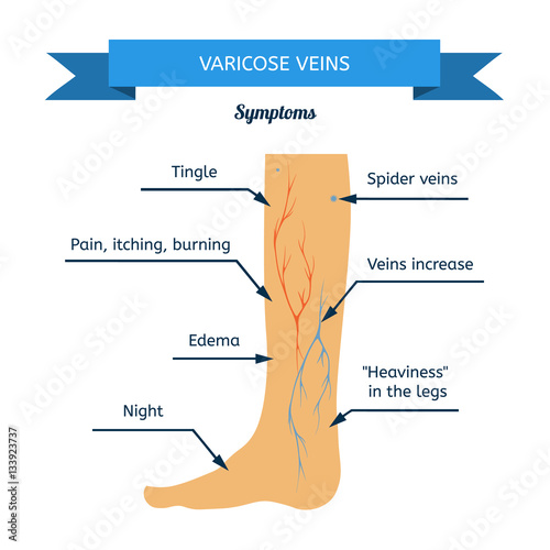 Symptoms of varicose veins. Women leg veins in profile