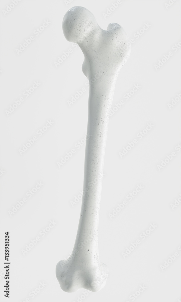 Fracture of the femur - breakpoints - 3D Rendering