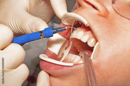 Dental hygiene and beauty procedures in the dental office, close up of teeth whitening treatment photo