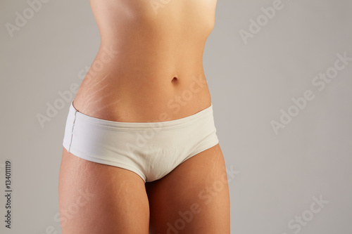 Unretouched skin exhibits stretch marks and other imperfections. photo