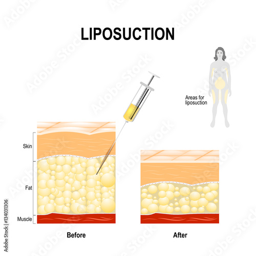  Human Skin layer before and after Liposuction