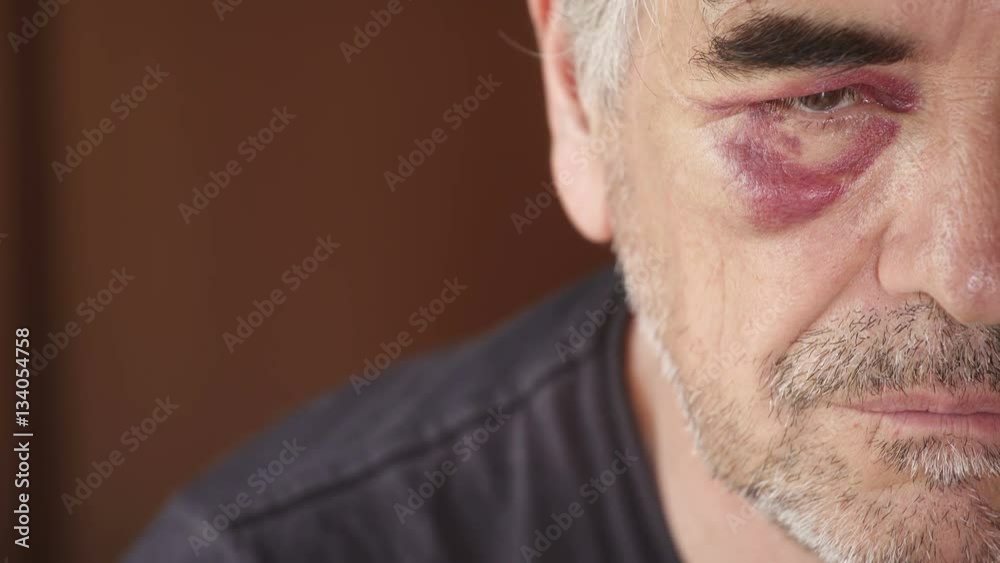 mature man with a black eye after a fight mature man with a black eye after a fight