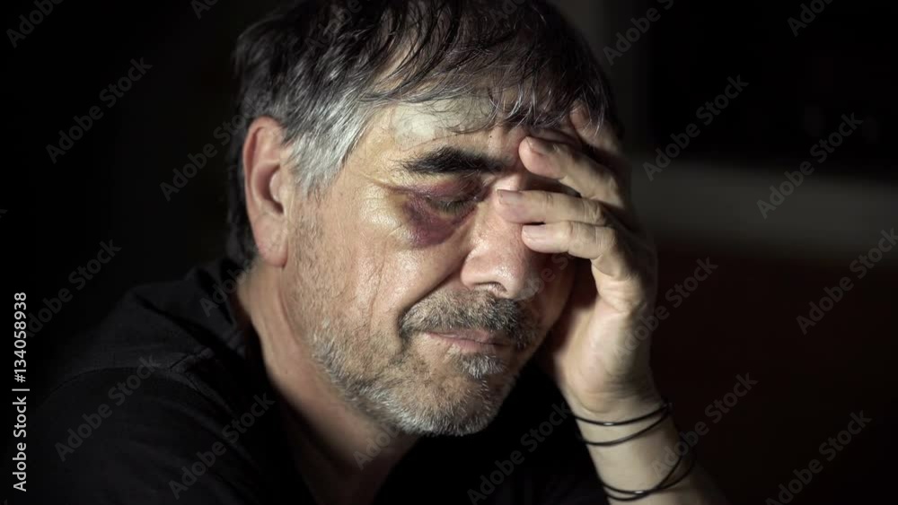 man drunk with a sad black eye because he thinks its addiction man drunk with a sad black eye because he thinks its addiction