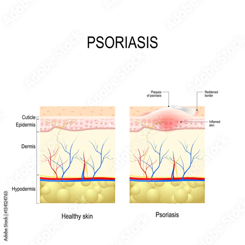  Healthy skin close up and skin with the plaque psoriasis