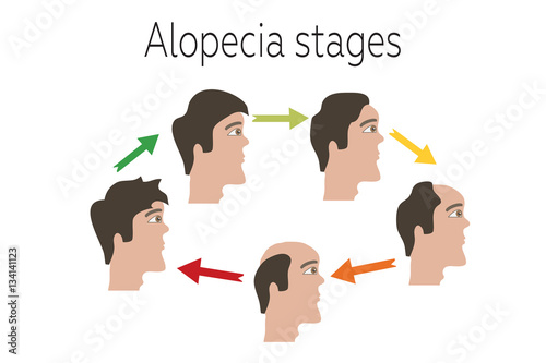 Alopecia stages set.  Male baldness. Male hair loss pattern.   Vector illustration.