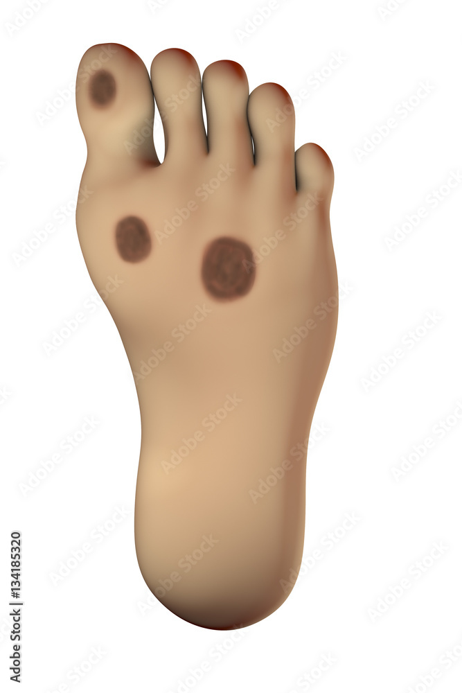 Diabetic foot ulcer, 3D illustration showing common location of diabetic ulcer lesions