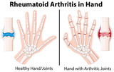 Diagram showing rheumatoid arthritis in hand