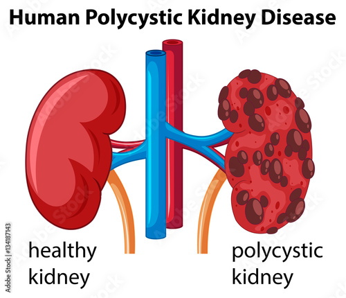 Diagram showing human polycystic kidney disease
