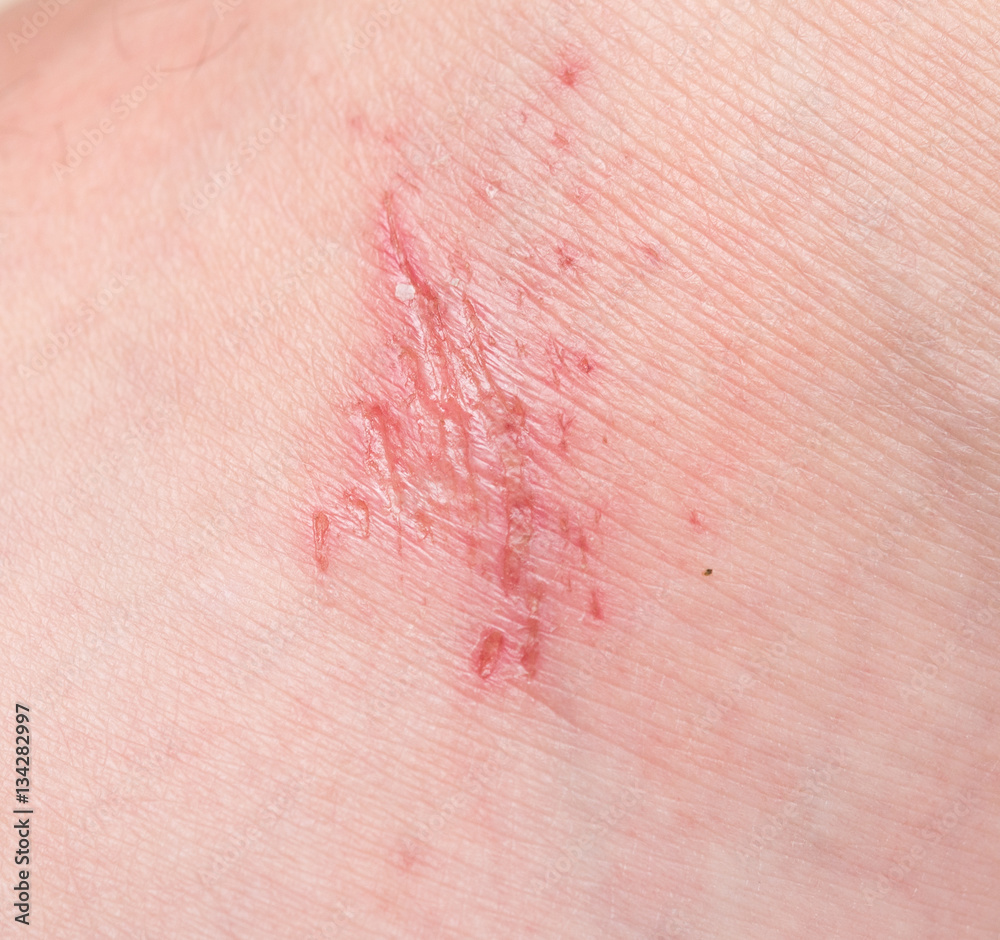 wound on skin