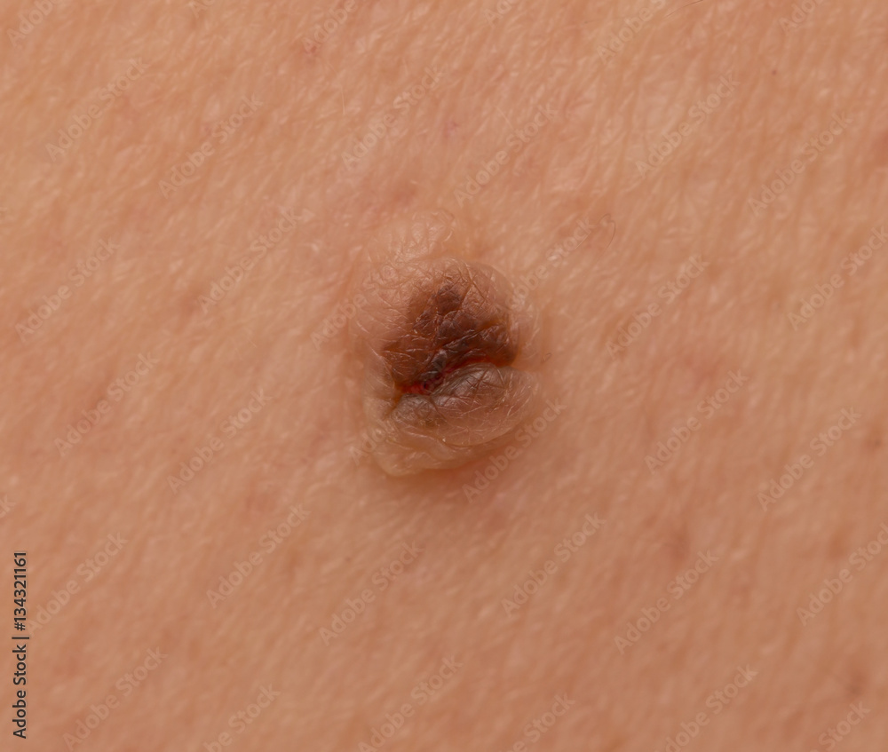Fototapeta premium a mole on the skin