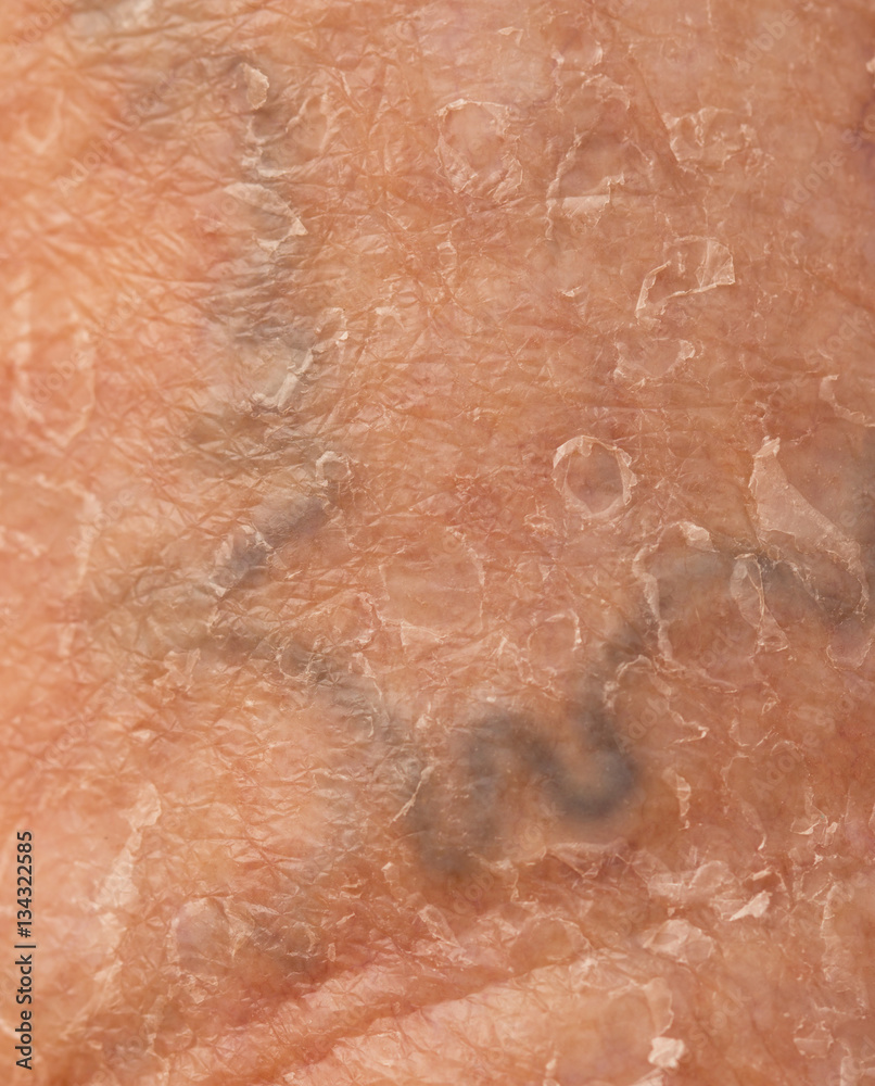 Fototapeta premium varicose veins on the skin
