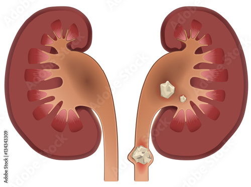 Nephrolithiasis kidney stones disease