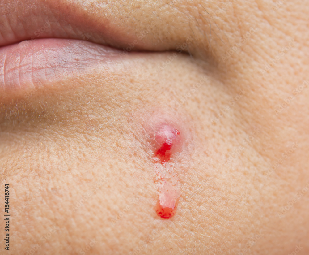 Acne with blood and pus Acne with blood and pus