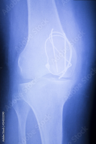 Knee joint implant xray