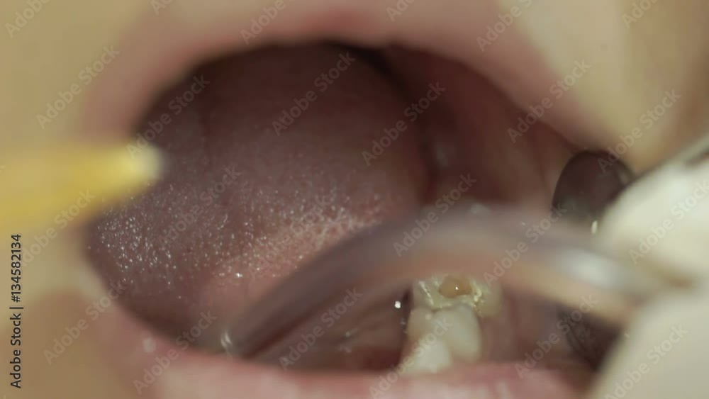 dentist uses the syringe gently into the mouth of a child