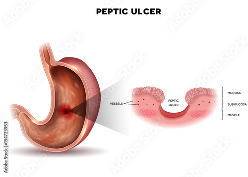 Peptic ulcer of the stomach, microscopic colorful anatomy on a white background photo