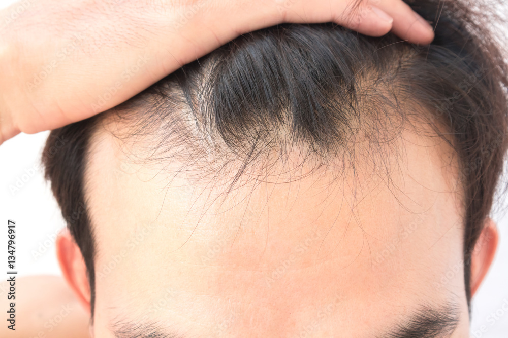Young man serious hair loss problem for health care shampoo and Young man serious hair loss problem for health care shampoo and