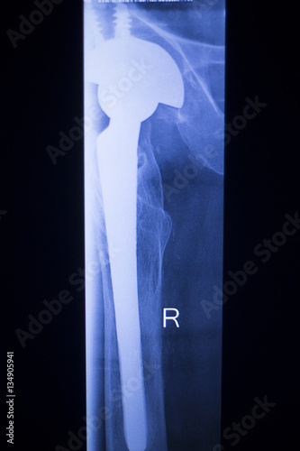 Hip joint replacement xray