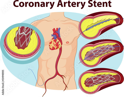 Vector illustration of Coronary artery stent