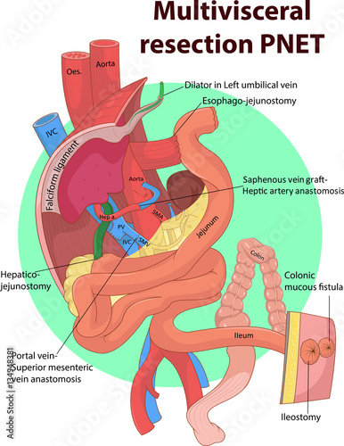Vector illustration of Intestinal and Multivisceral  anatomy