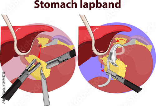 Vector illustration of Stomach gastric band