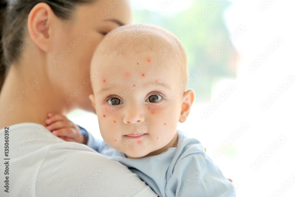 Mother holding little boy with red pimples at home. Chicken pox concept Mother holding little boy with red pimples at home. Chicken pox concept