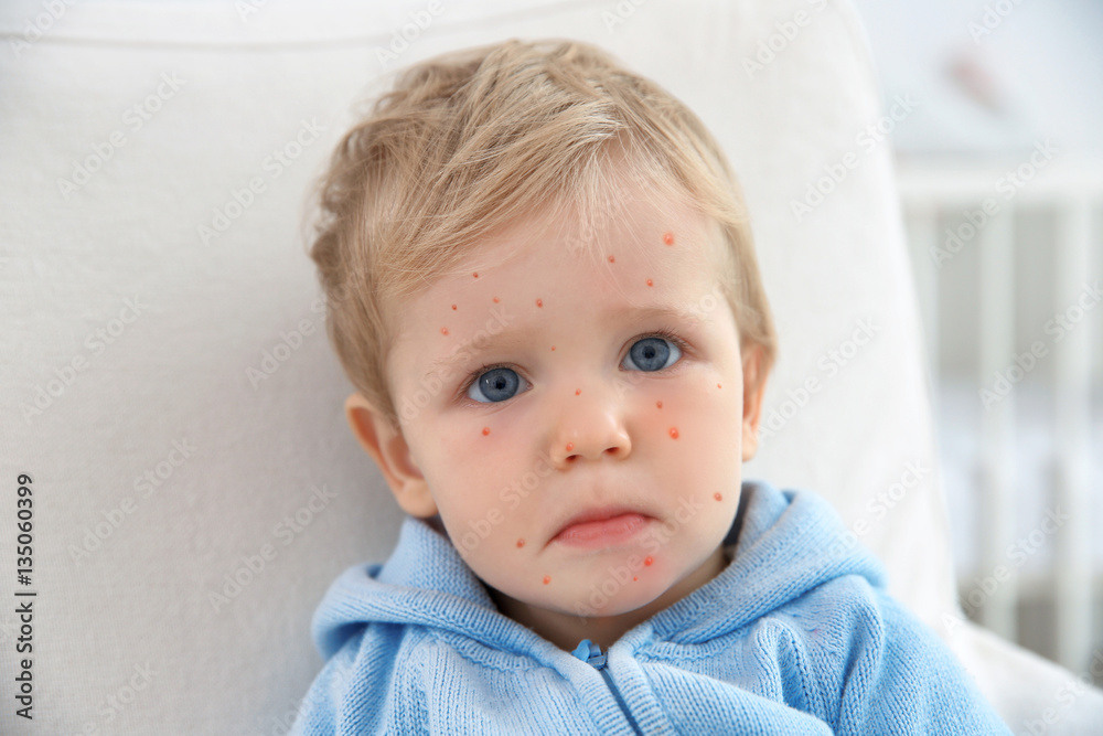 Little boy with red pimples at home. Chicken pox concept Little boy with red pimples at home. Chicken pox concept
