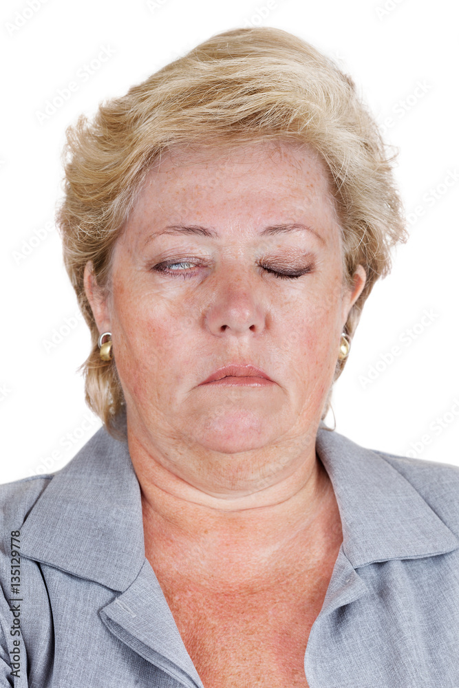 Bell's Palsy - one eye won't close completely