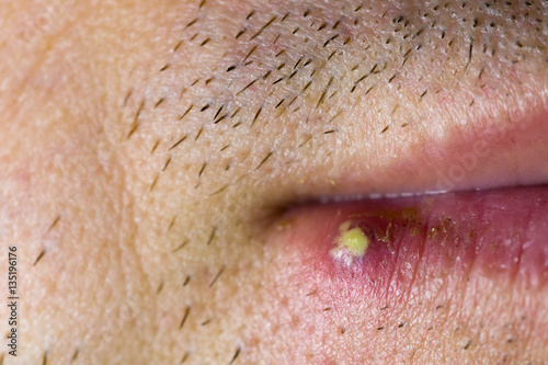 Принти на полотні Virus herpes on male lip