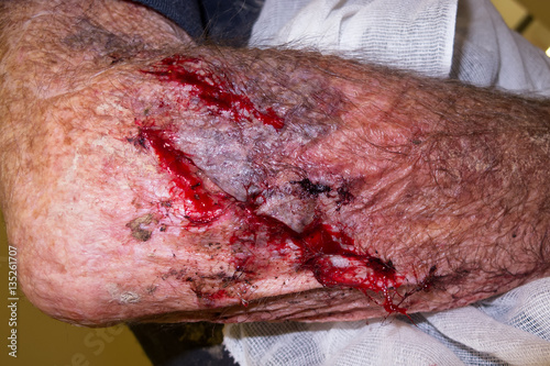Arm wound on arm of Senior man