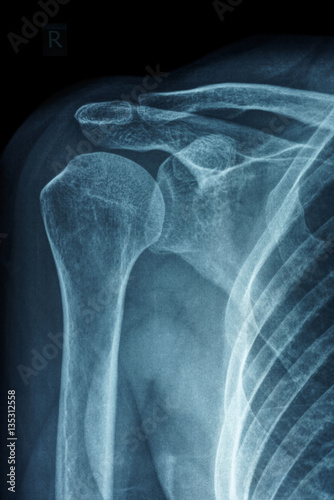 X-ray film of primary frozen shoulder or adhesive capsulitis of Asian female patient  photo